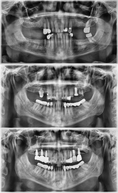Dental Implants in Libby